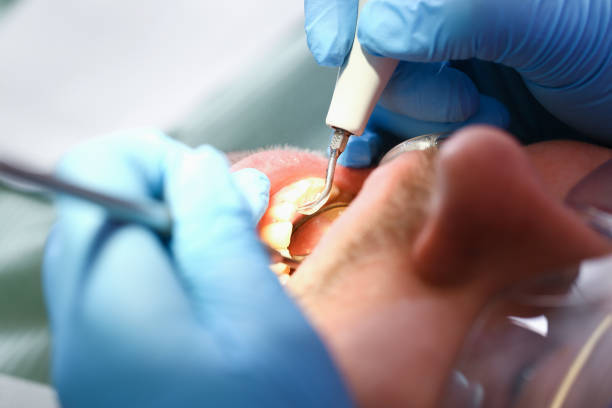 Best Emergency Treatment for Toothache in Dakota Dunes, SD